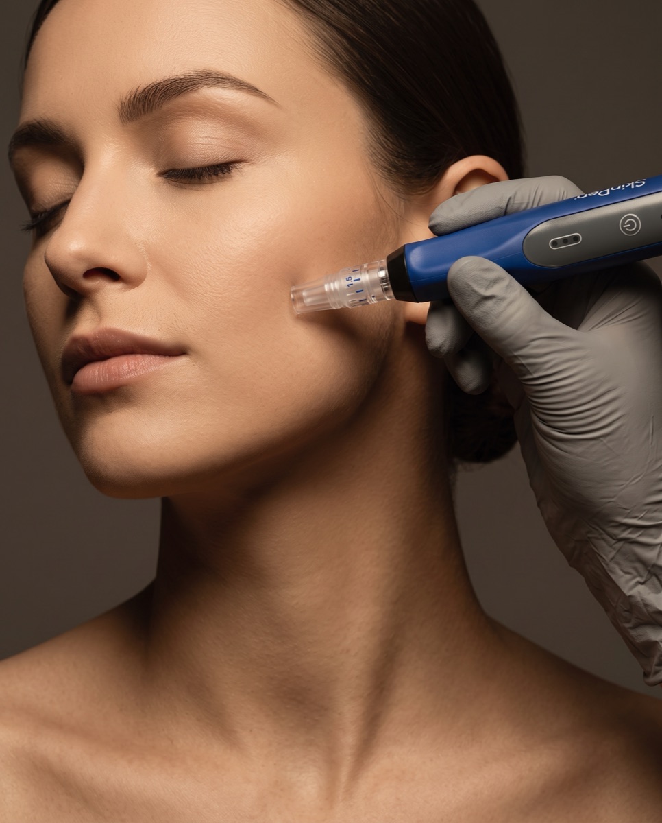 Urządzenie SkinPen® trzymane tuż przy skórze policzka przez dłoń w rękawiczce