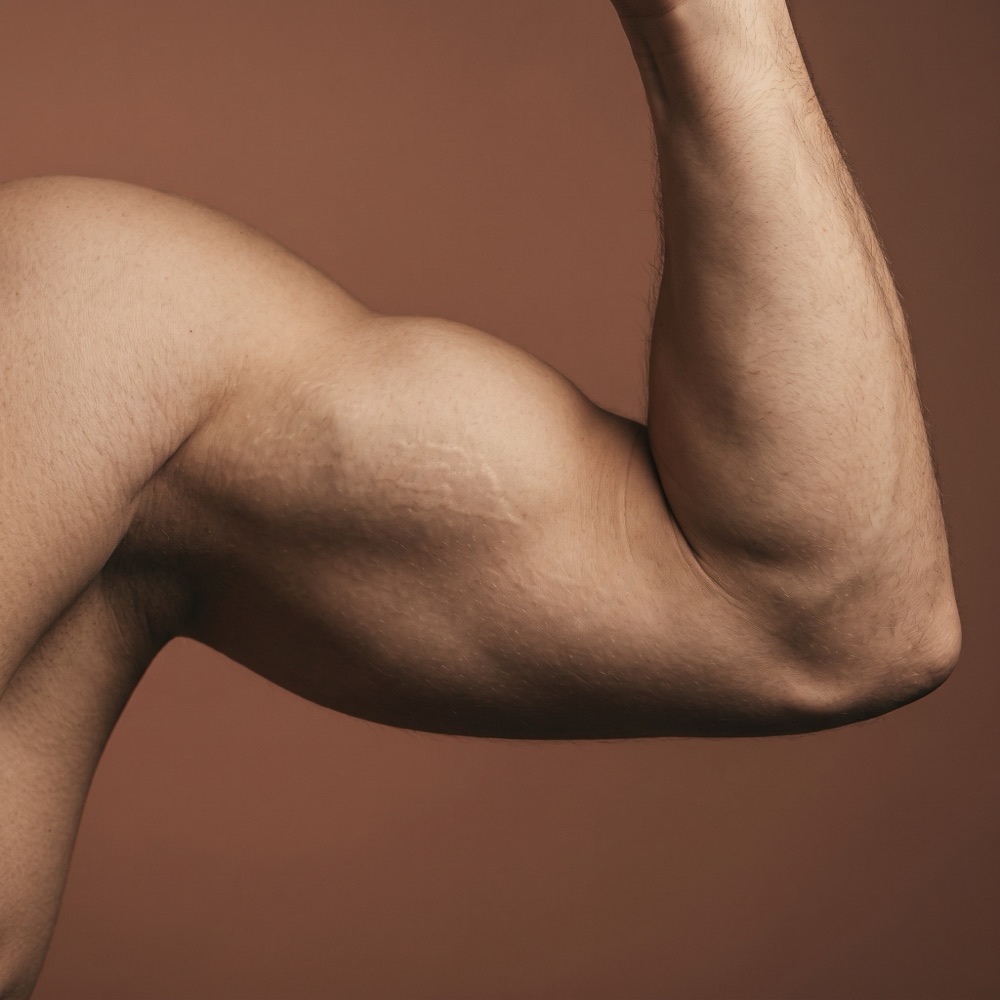 Zabieg karboksyterapii — biceps z widocznymi rozstępami